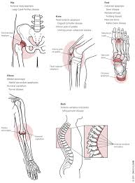 Juvenile Osteochondrosis - Hình ảnh minh họa